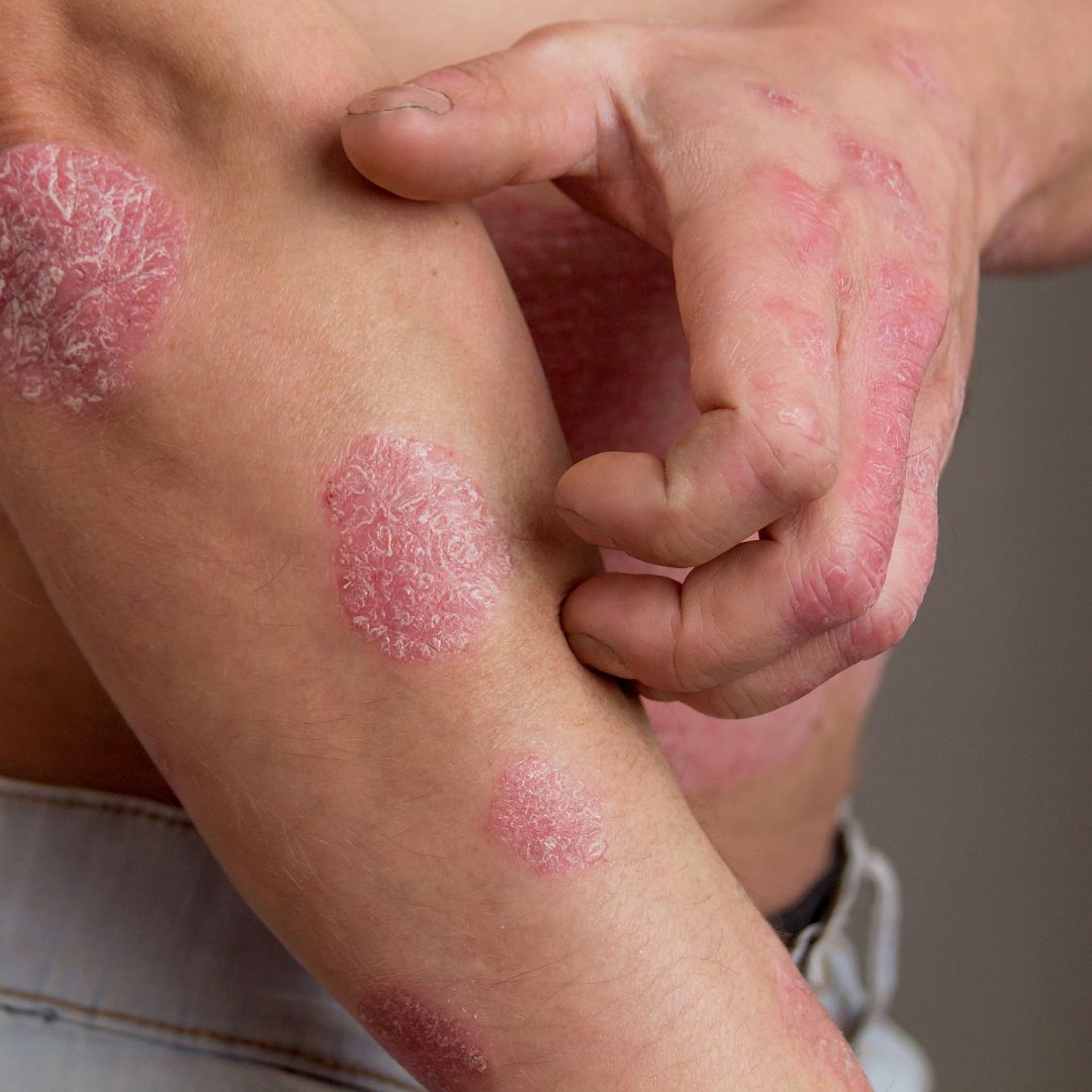 Eczema is an uncommon symptom of food intolerance